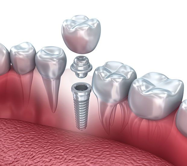 Virginia Beach Dental Implant Surgery