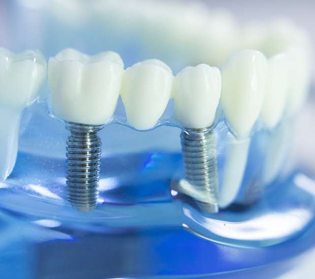 Virginia Beach Dental Implants